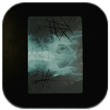 Radiograph of a Pelvis Icon